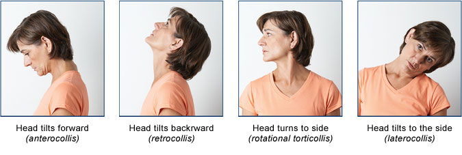 Types of head movement with cervical dystonia