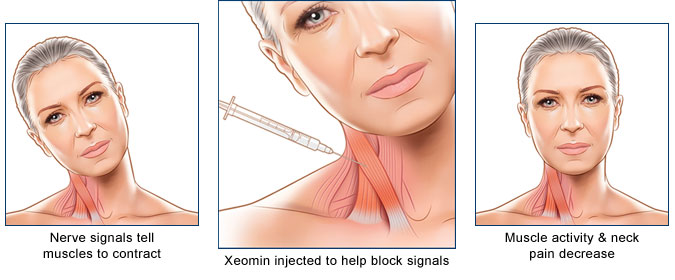 How Xeomin works to relieve muscle pain and stiffness in neck and shoulders