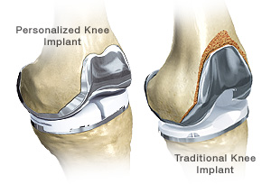 Conformis