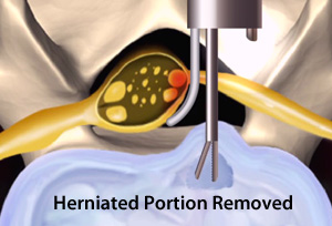 Lumbar Micro Endoscopic Discectomy