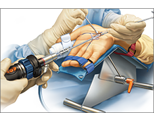 Endoscopic procedure utilizing AM Surgical instruments