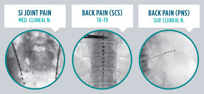 Spinal Cord Stimulator for Treating Chronic Back Pain