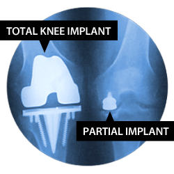 Shoulder resurface with Arthrosurface