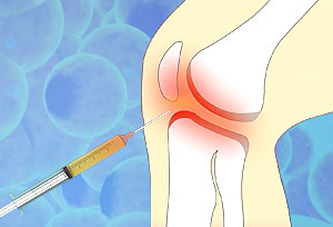 Lipogems adipose tissue procedure