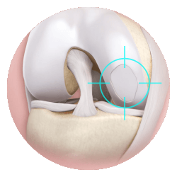 MACI ACI Cartilage Repair