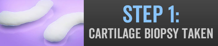 MACI Step 1: Cartilage Biopsy Taken