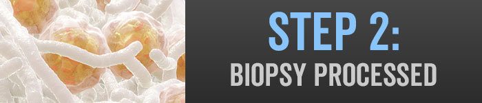 MACI Step 2: Biopsy Processed