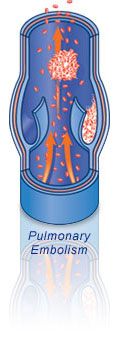 pulmonary embolism