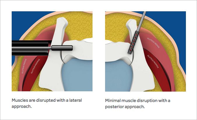 Rialto SI Joint Procedure