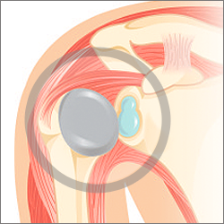 Partial knee replacement