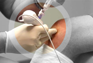 Trice Medical mi-eye single portal scope