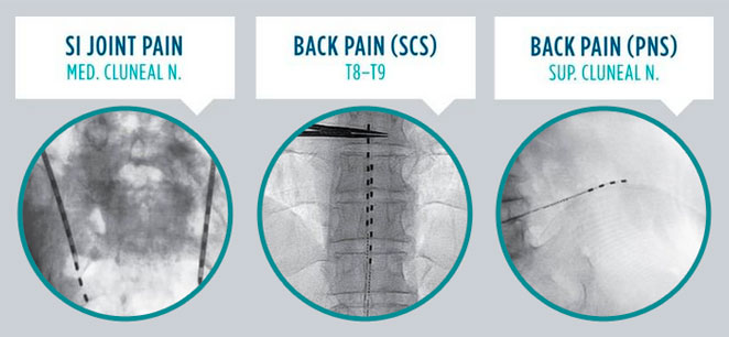 X-rays of Stimwave Spinal Implants